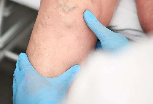 Close-up of varicose veins on a leg, showing the twisted, enlarged, and dark purple or blue veins typical of this condition, against a neutral background for clarity.