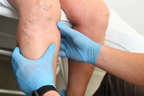 Effective Varicose Vein Treatments in New Jersey